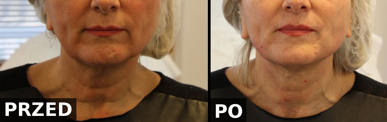 Porównanie efektów przed i bezpośrednio po zabiegu wprowadzenia nici PDO w okolicy żuchwy i szyi. PerfectLift Robert Janczura Medycyna Estetyczna Kraków Kielce Aqualyx, Nici BARB 4D, Laser CO2, VPL, Cosmelan, powiększanie ust, botox, botoks, makijaż permanentny, kwas hialuronowy, wypełniacze, mezoterapia, lifting twarzy